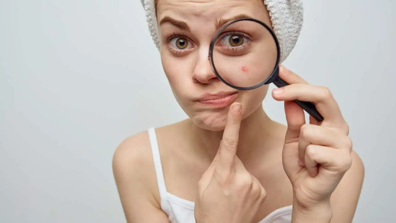Soigner l'acné, les erreurs à éviter