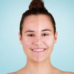 Naturopathie et Acné : Comprendre et Apaiser l’Acné Adulte